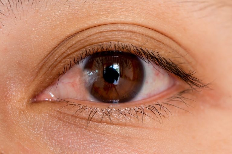 A practical guide to managing pterygium with eyedrops and simple remedies