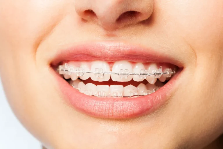 Affordable Discreet Orthodontics: What to Expect and Save