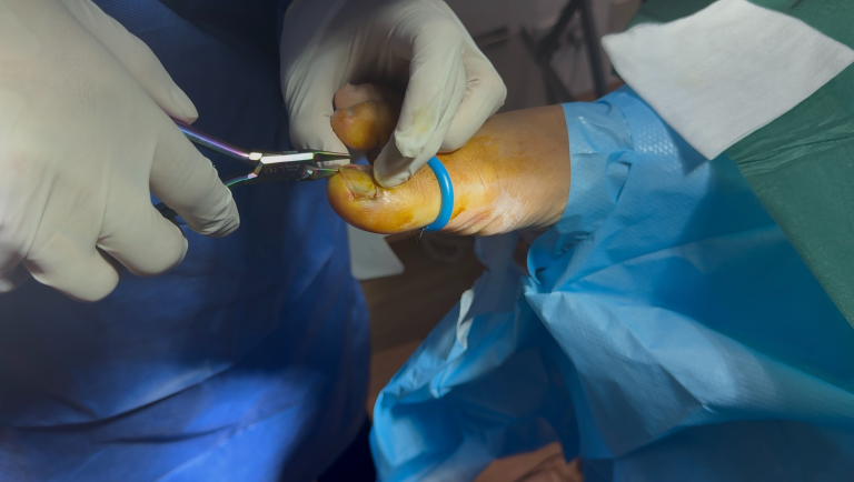 Effective ways to tackle fungal nail infections at home
