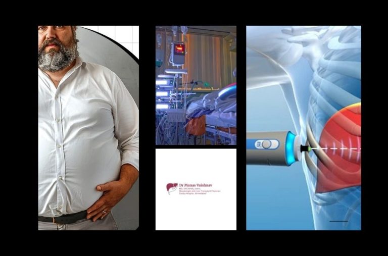 Liver Transplant in Ahmedabad and Gujarat – Advanced Care and Expert Treatment