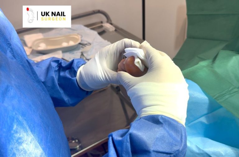 Dealing with painful toenail edges: care and removal options Dealing with painful toenail edges: care and removal options
