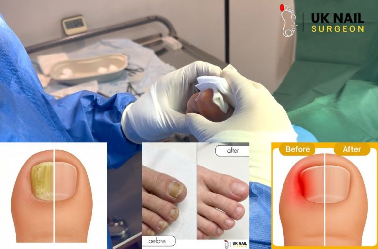 Effective Fungal Nails Surgery for Healthy Nails | Expert UK Nail Surgeon