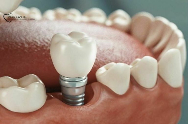 Urgencias dentales en Pozuelo: guía práctica para pacientes